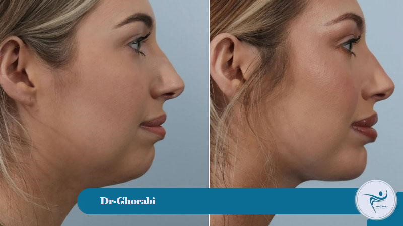Who are suitable candidates for a chin implant? 