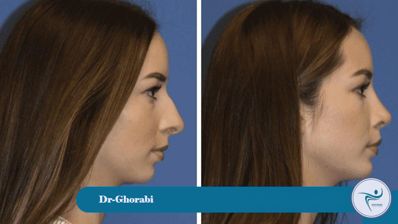 What is the chin implant procedure like