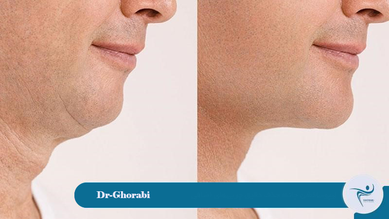 Chin liposuction; precise removal of excess fat 