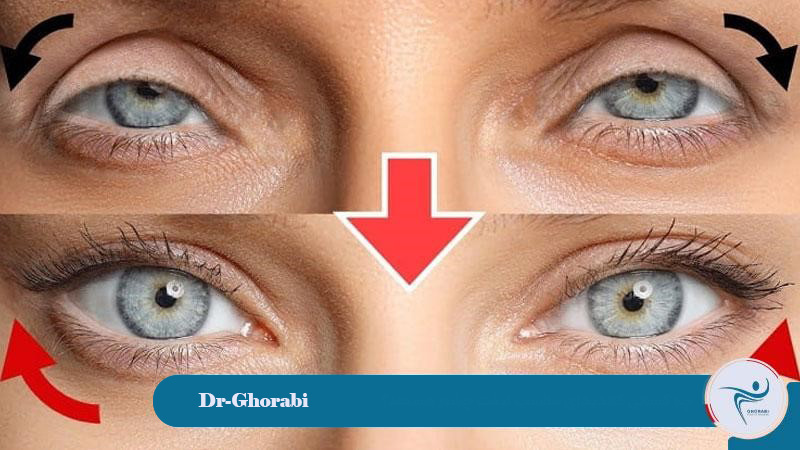 Who are suitable candidates for an eyelid lift? 