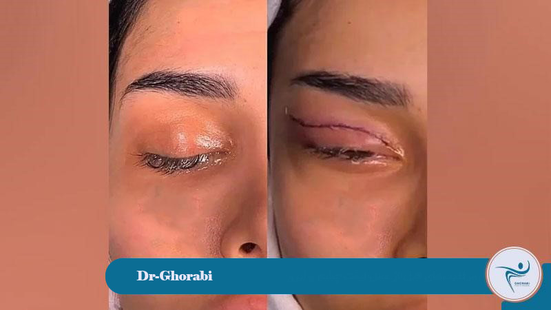 Pre-operative care for eyelid and eyebrow lift 
