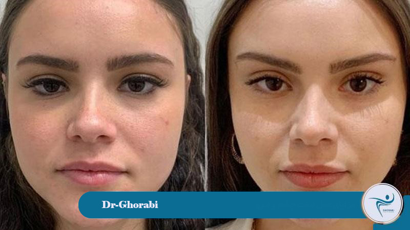 Benefits of eye and eyebrow lift surgery 