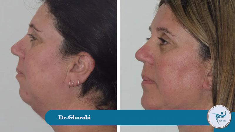Who are suitable candidates for genioplasty? 