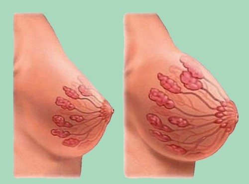 تصویر ماموپلاستی (کوچک کردن سینه)