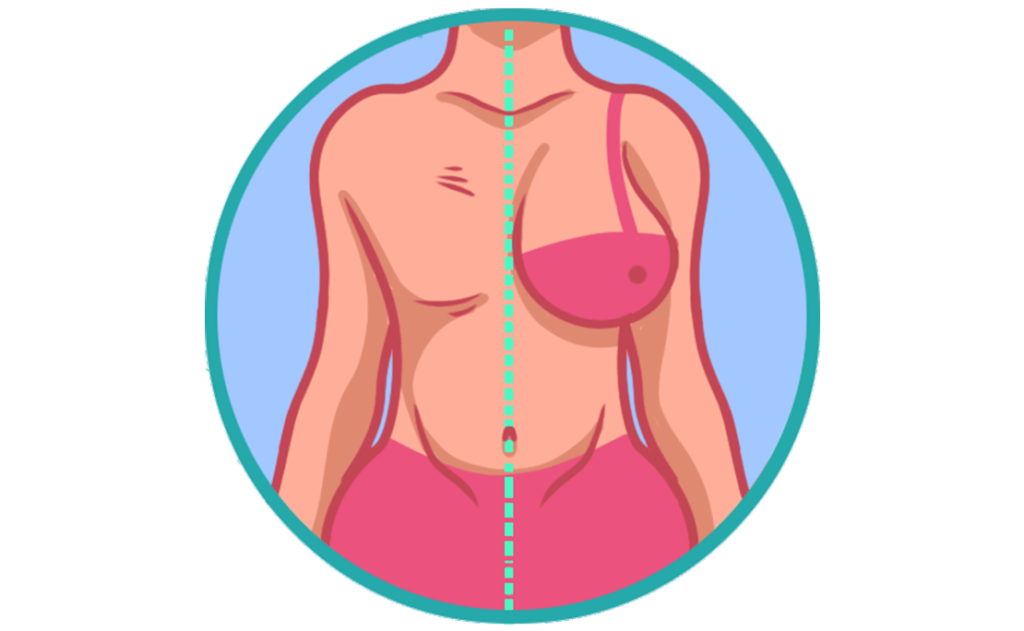Breast cancer reconstruction