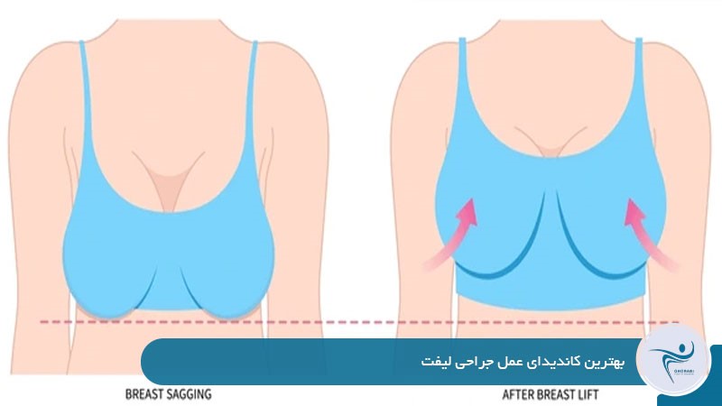 بهترین کاندیدای عمل جراحی لیفت سینه
