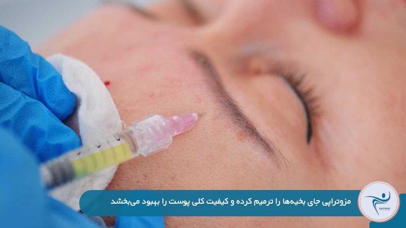مزوتراپی؛ راهکاری برای کاهش و ترمیم جای بخیه لیفت شقیقه