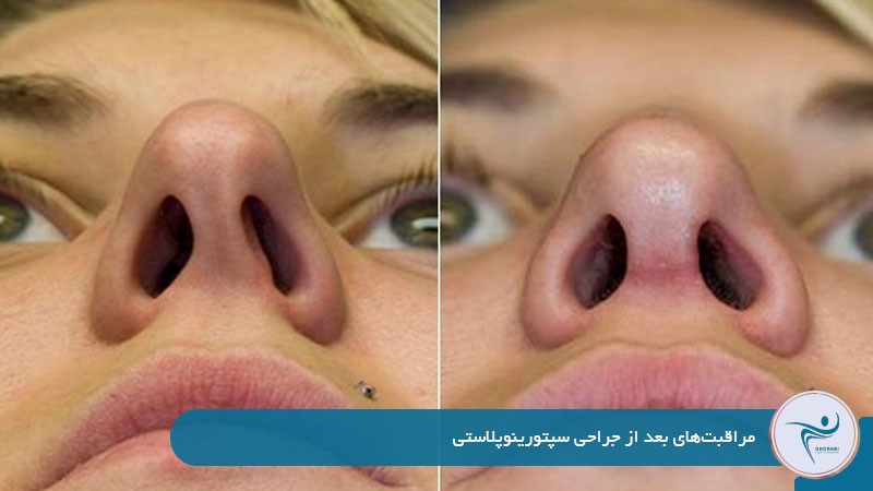 مراقبت‌های بعد از جراحی سپتورینوپلاستی 