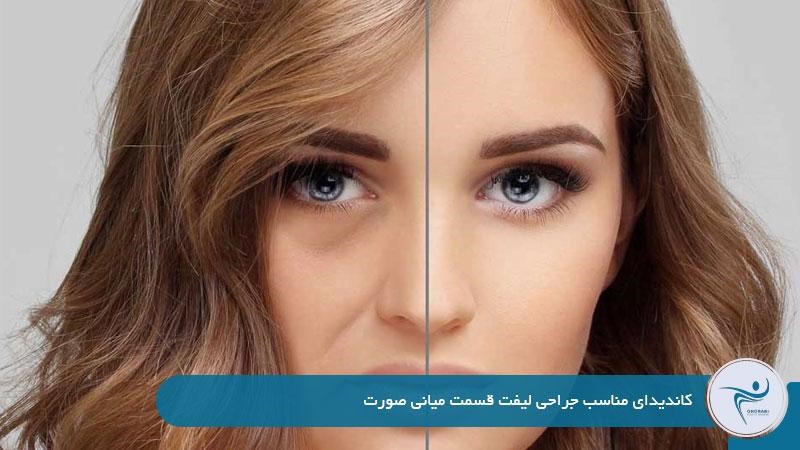 کاندیدای مناسب جراحی لیفت قسمت میانی صورت 