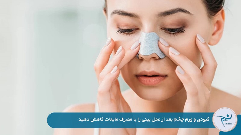 رفع تورم صورت بعد از عمل بینی