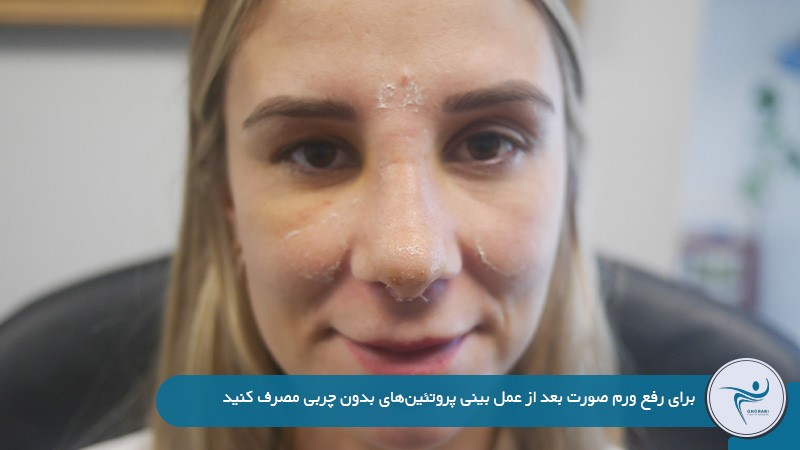 ورم پرههای بینی بعد از عمل بینی