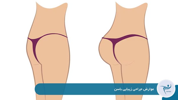 عوارض جراحی زیبایی باسن 