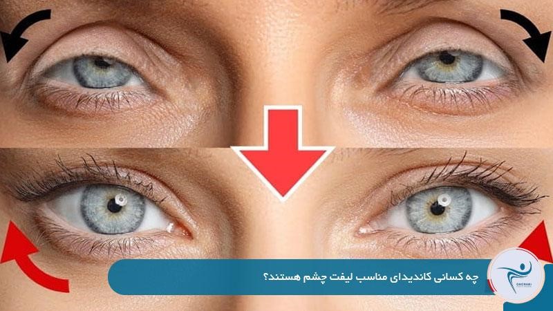 چه کسانی کاندیدای مناسب لیفت چشم هستند؟ 