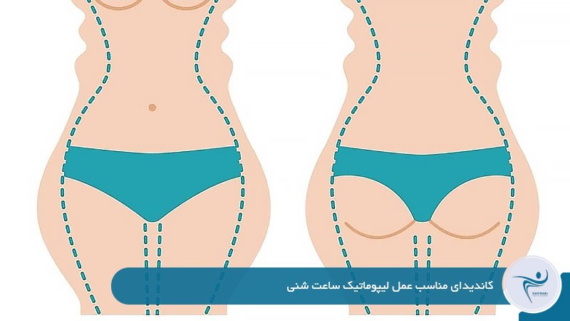 کاندیدای مناسب عمل لیپوماتیک ساعت شنی 