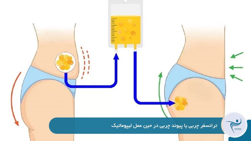 ترانسفر چربی یا پیوند چربی در حین عمل لیپوماتیک 