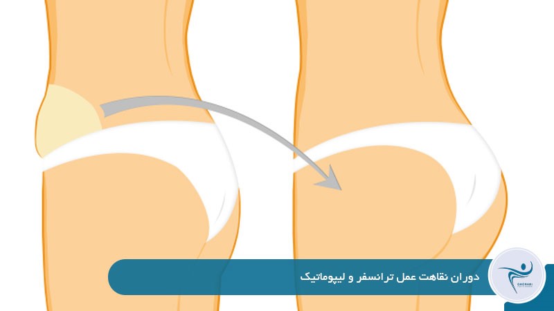 دوران نقاهت عمل ترانسفر و لیپوماتیک 