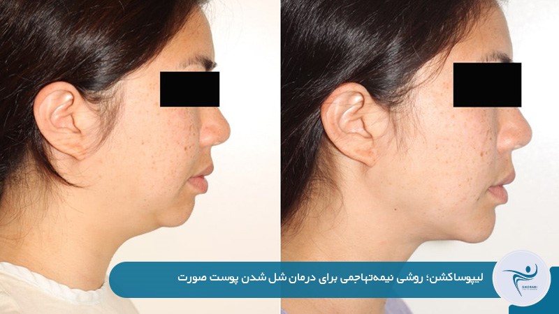 از بین بردن افتادگی پوست صورت