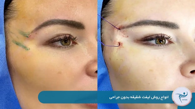 انواع روش لیفت شقیقه بدون جراحی 