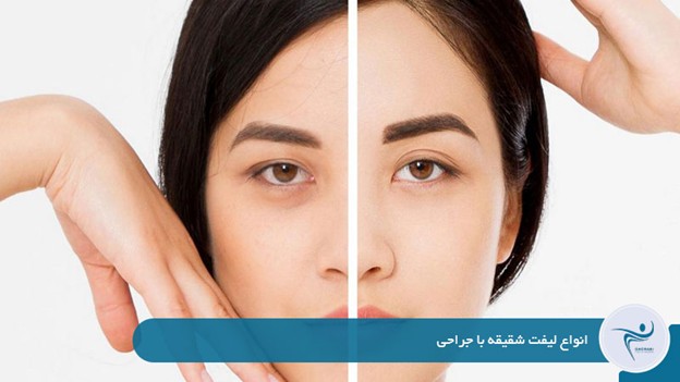 انواع لیفت شقیقه با جراحی 