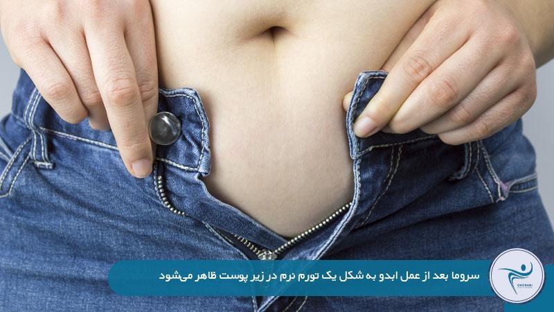 علائم سروما یا تجمع مایع بعد از عمل ابدومینوپلاستی