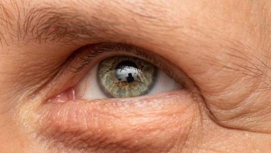 Brow ptosis