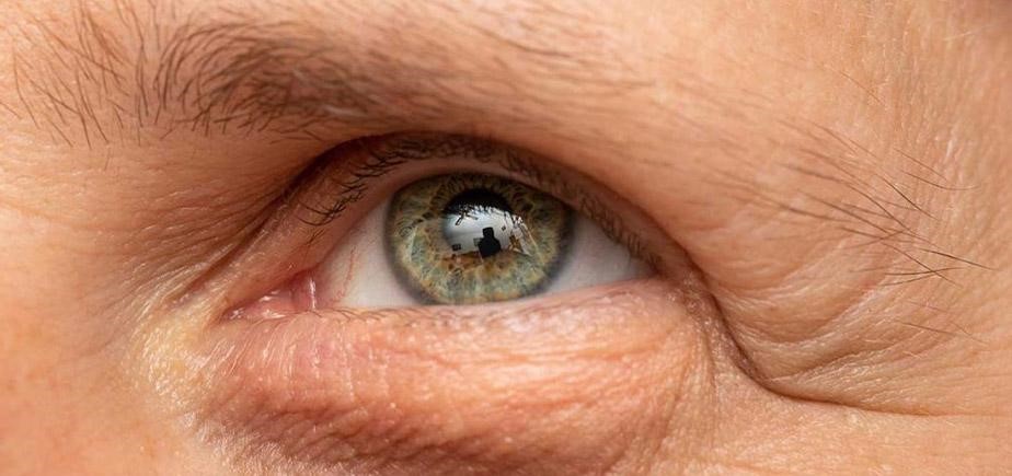 Brow ptosis