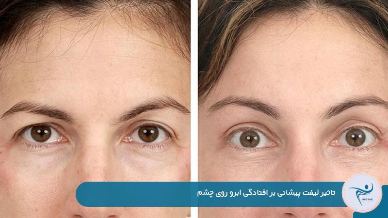 درمان افتادگی ابرو در نوجوانی