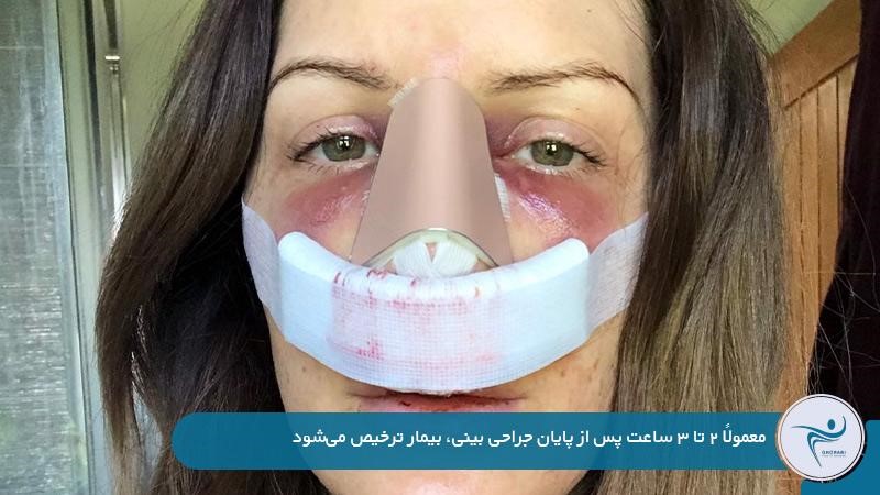 مدت زمان ترخیص عمل زیبایی بینی