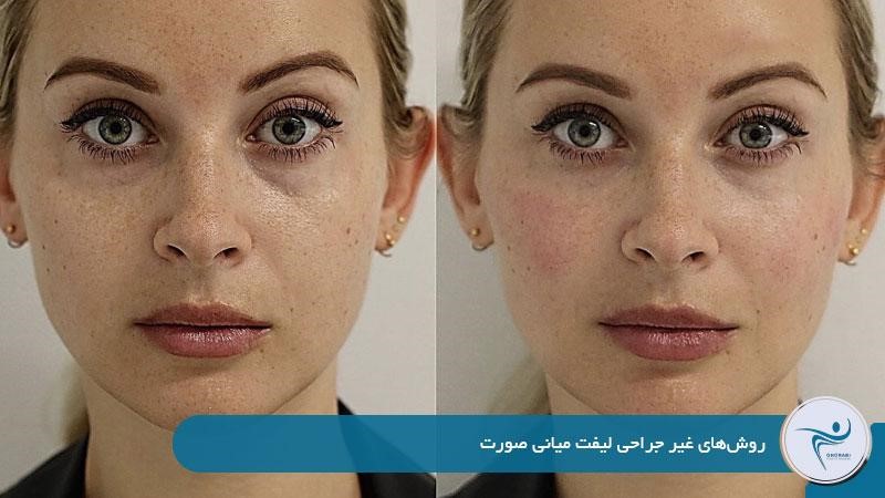 روش‌های غیر جراحی لیفت میانی صورت 