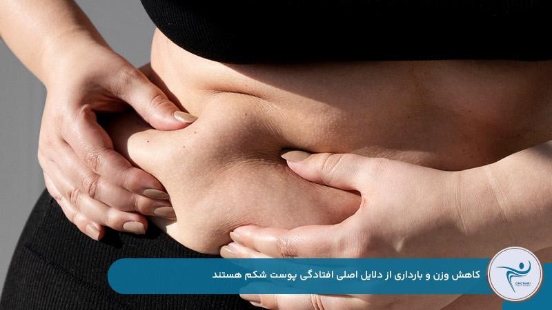 کاهش وزن و بارداری از دلایل اصلی افتادگی شکم
