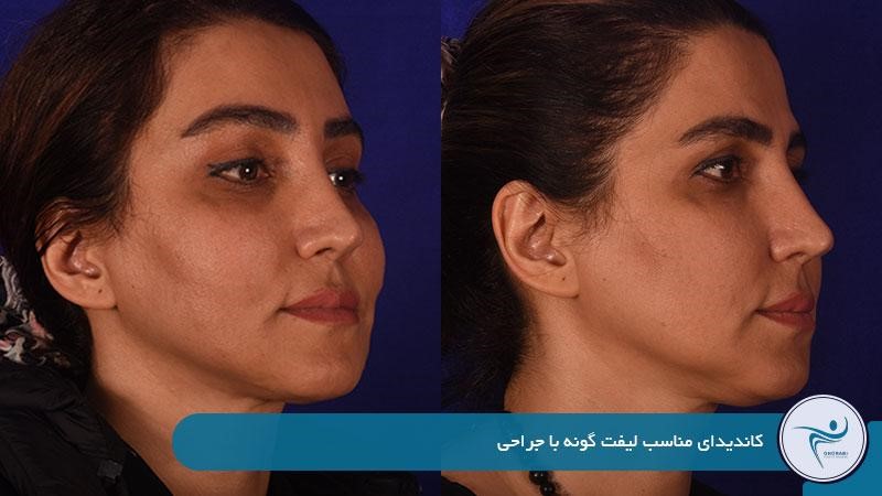 کاندیدای مناسب لیفت گونه با جراحی 