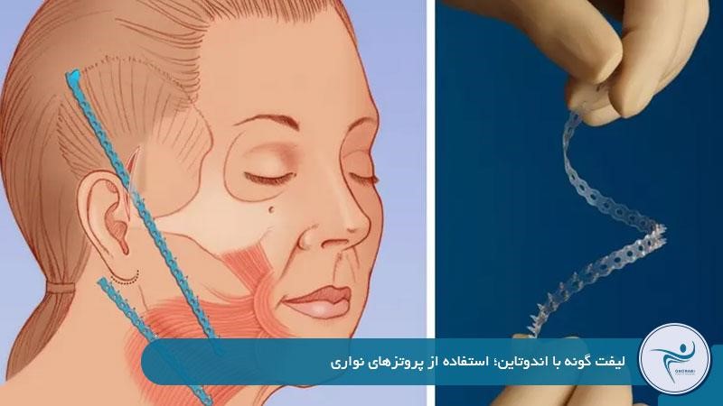 لیفت گونه با اندوتاین؛ استفاده از پروتزهای نواری 