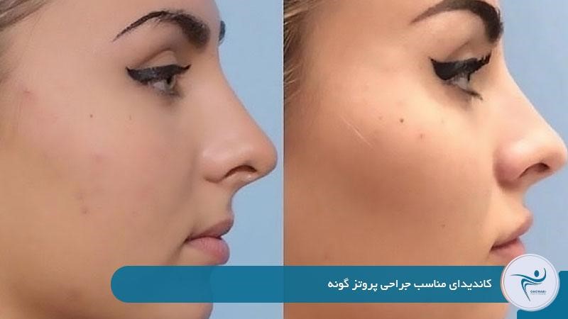 کاندیدای مناسب جراحی پروتز گونه 