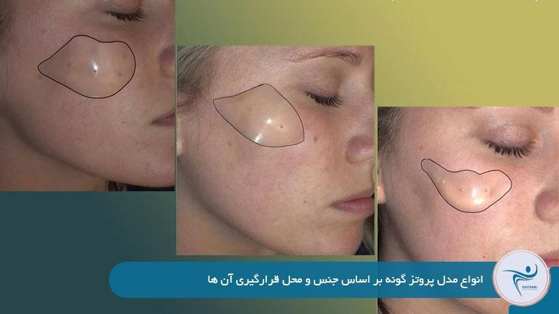 انواع مدل پروتز گونه بر اساس جنس و محل قرارگیری آن‌ها 