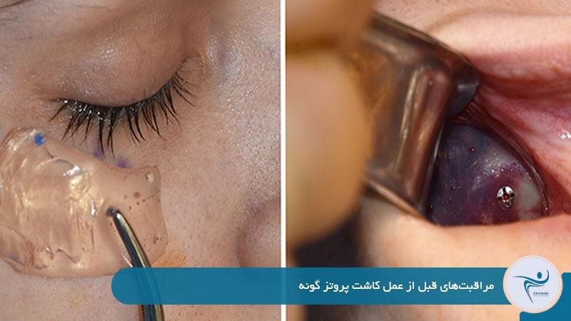 مراقبت‌های قبل از عمل کاشت پروتز گونه 