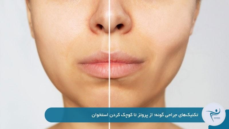 تکنیک‌های جراحی گونه؛ از پروتز تا کوچک کردن استخوان
