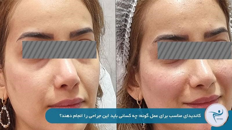 کاندیدای مناسب برای عمل گونه؛ چه کسانی باید این جراحی را انجام دهند؟

