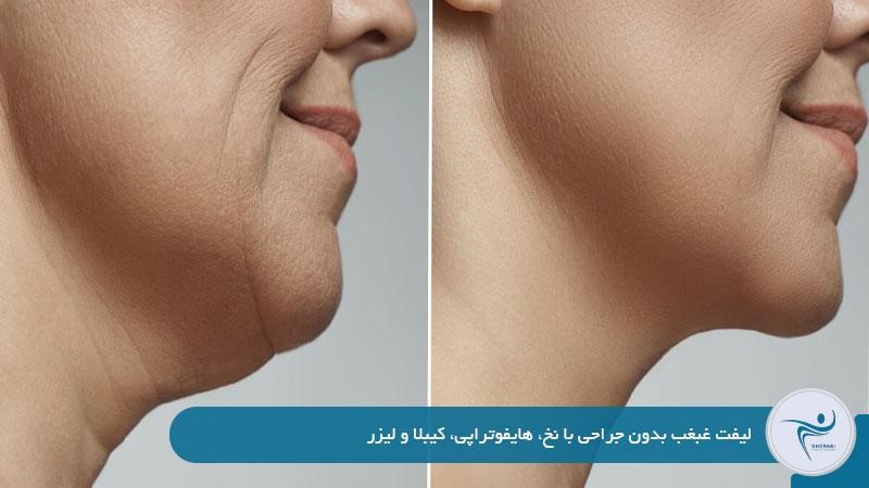 لیفت غبغب بدون جراحی با نخ، هایفوتراپی، کیبلا و لیزر
