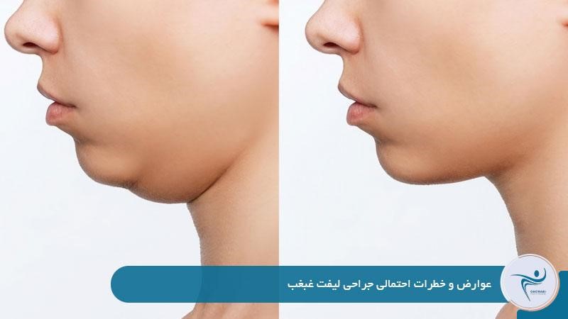 عوارض و خطرات احتمالی جراحی لیفت غبغب