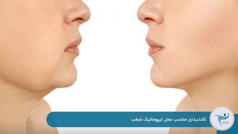 کاندیدای مناسب عمل لیپوماتیک غبغب 