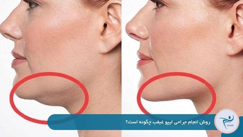 روش انجام جراحی لیپو غبغب چگونه است؟ 