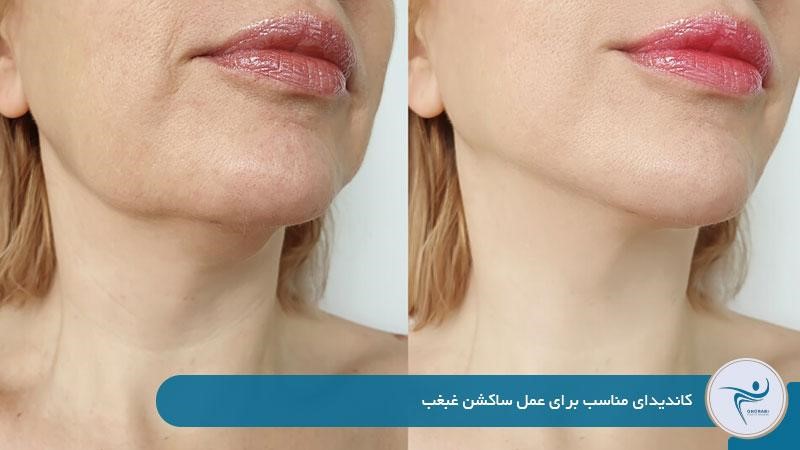 کاندیدای مناسب برای عمل ساکشن غبغب 