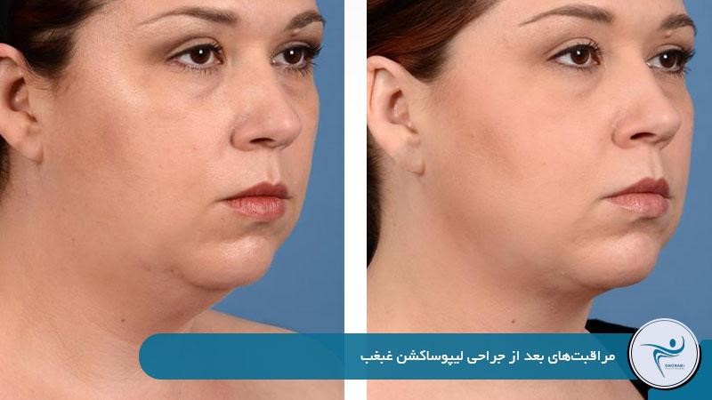 مراقبت‌های بعد از جراحی لیپوساکشن غبغب 