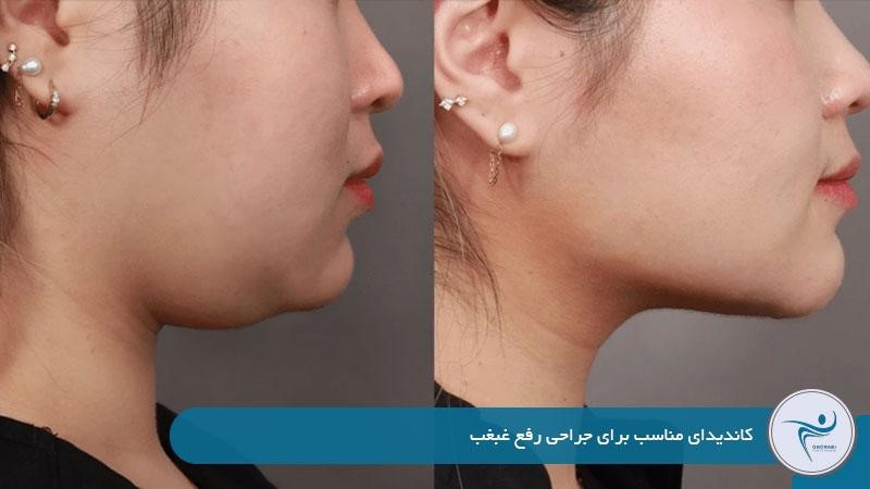 کاندیدای مناسب برای جراحی رفع غبغب 