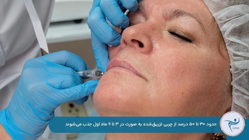 ماندگاری تزریق چربی به صورت 3 تا 10 سال