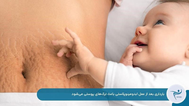 بروز ترک‌های پوستی بر اثر بارداری بعد از عمل ابدومینوپلاستی