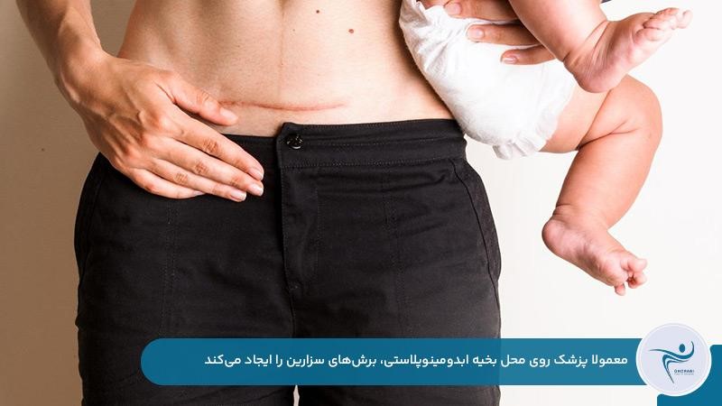 ایجاد برش سزارین روی محل بخیه ابدومینوپلاستی