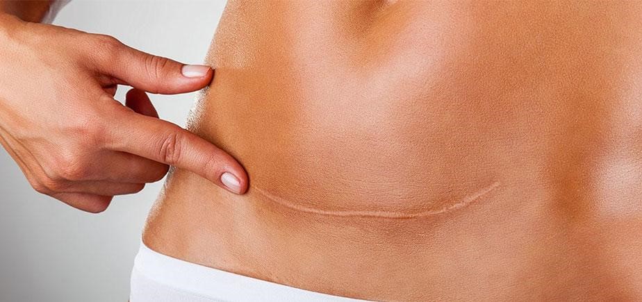 بررسی همه روشهای از بین بردن خط بخیه ابدومینوپلاستی در مجله دکتر غرابی
