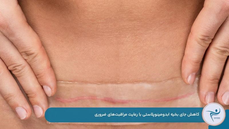 رعایت مراقبتها برای کاهش جای بخیه ابدومینوپلاستی