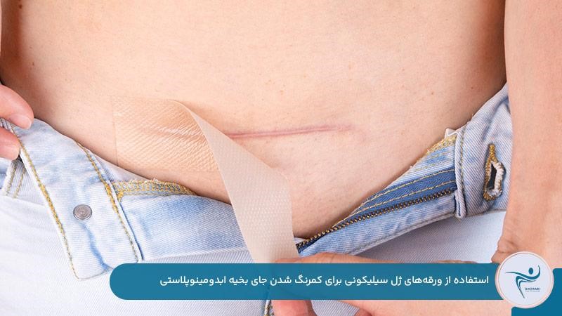 استفاده از ورقههای ژل سیلیکونی برای نماندن جای بخیه ابدومینوپلاستی